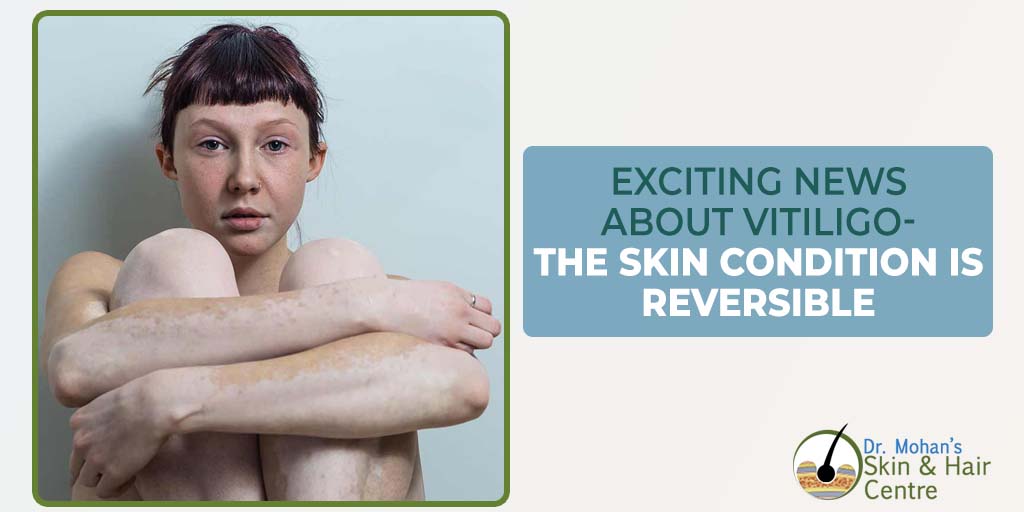 Exciting News About Vitiligo- The Skin Condition is Reversible