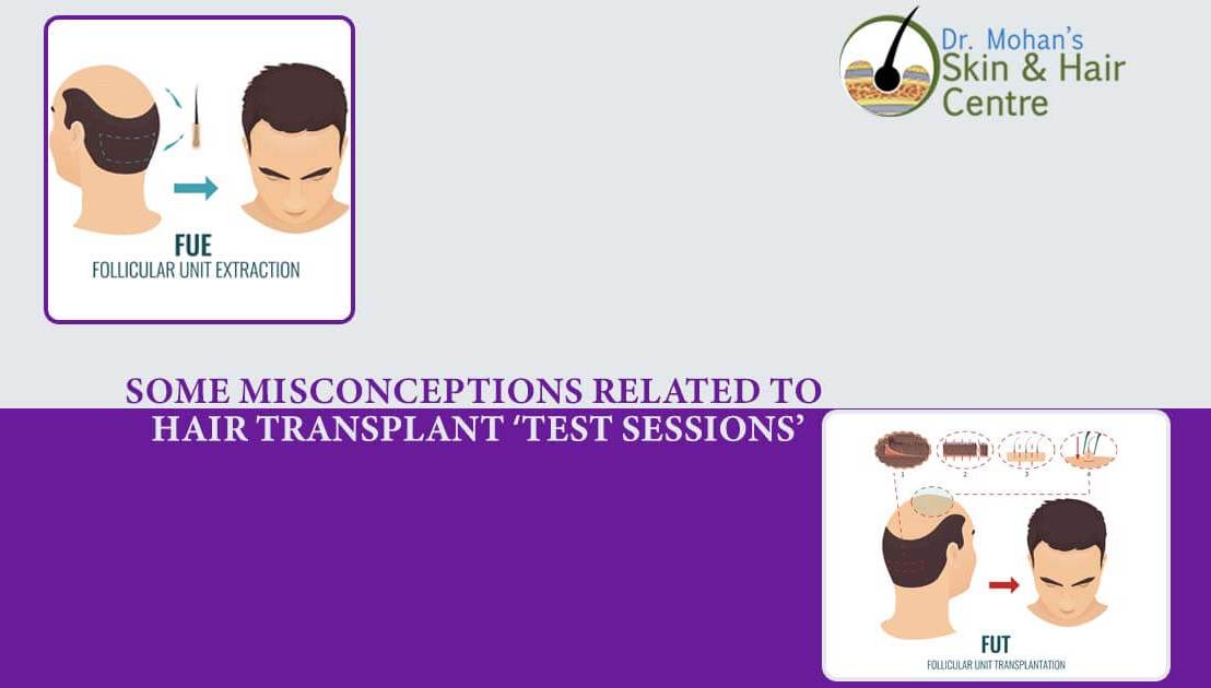 Some Misconceptions Related To Hair Transplant ‘Test Sessions’